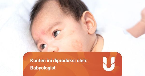 Apa itu Dermatitis Atopik atau Eksim?